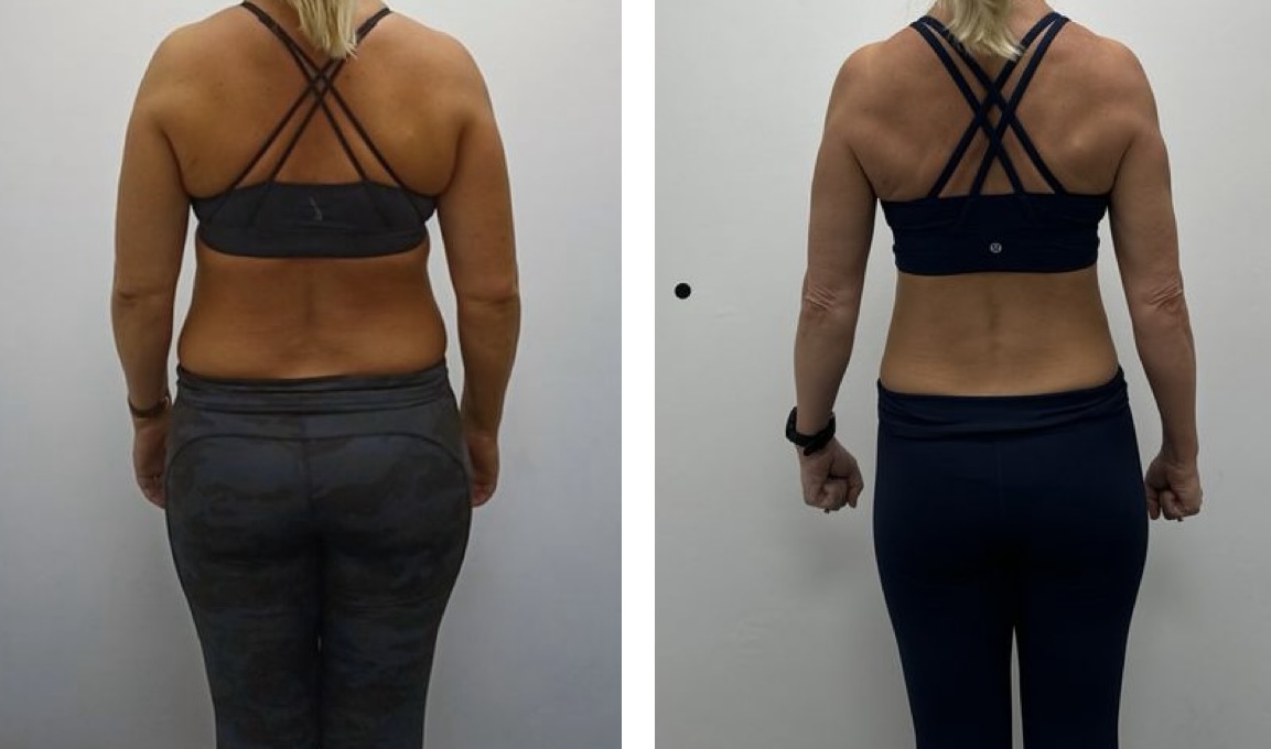 Client C back view, before and after
